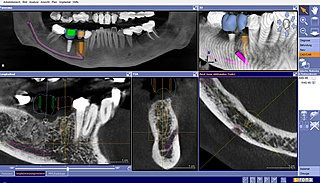 implantatplanung nerv