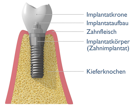 Implantatkrone